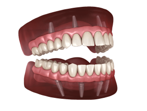 Willow Grove Dental Implants Center - All-on-4 Zirconia implants double Arch