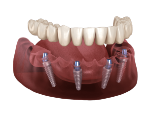 Willow Grove Dental Implants Center - All-on-4 Zirconia implants Single Arch