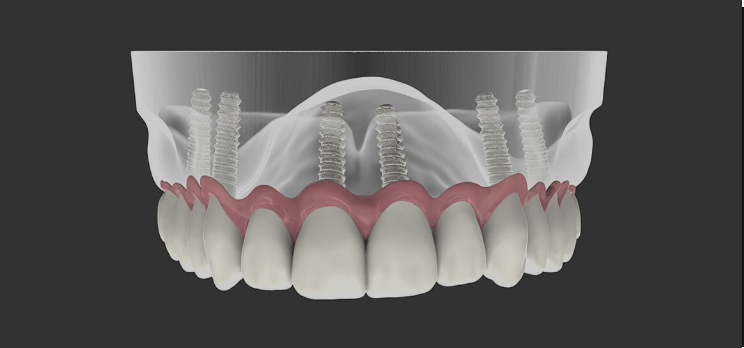 Willow Grove Dental Implants Center - Prosthetic Dentistry