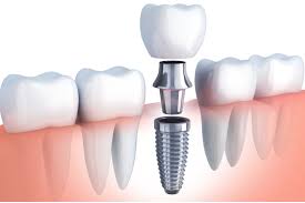 Willow Grove Dental Implants Center - Dental Implant